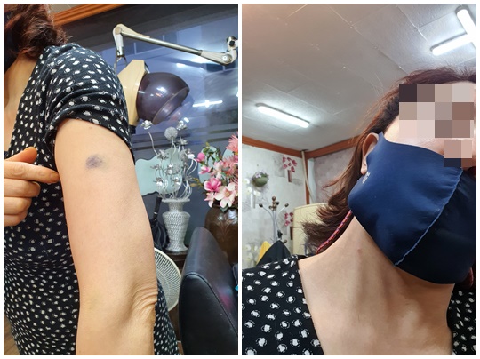 왼편은 AZ 백신 접종 부위, 오른편은 목 부위 사진. A 씨가 의식을 읽기 직전 찍은 사진이다.
