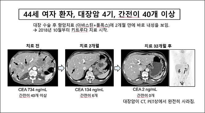 대장암 4기 환자에게 키트루다 투여 효과 사례(자료: 김찬 교수)