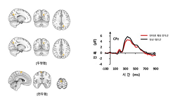 기능적 MRI 검사 결과 인터넷 게임 중독군은 정상대조군들보다 두정엽과 전두엽 부위에서 뇌 활성이 증가했다(좌측 사진). 청각 자극에 대한 뇌파 신호의 진폭은 인터넷 게임 중독군이 정상대조군보다 감소했다(우측 그래프)