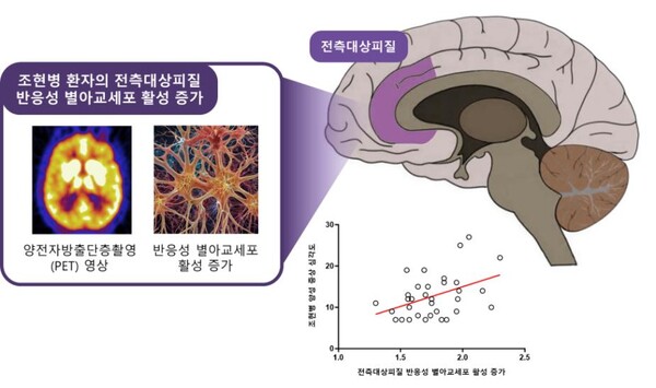 조현병 증상 새로운 원인 지표, 뇌 속 ‘반응성 별아교세포’ 활성 증가