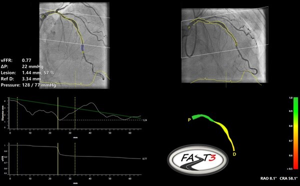 Pie Medical Imaging、FASTIII臨床試験の登録完了を発表