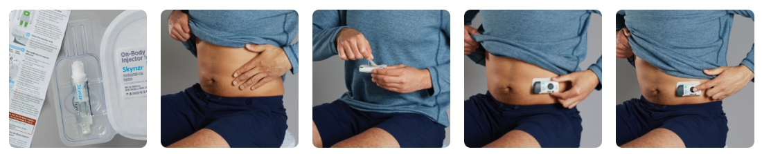 사진. 온바디 인젝터(On-Body Injector, OBI) 애브비 스카이리치 공식 홈페이지