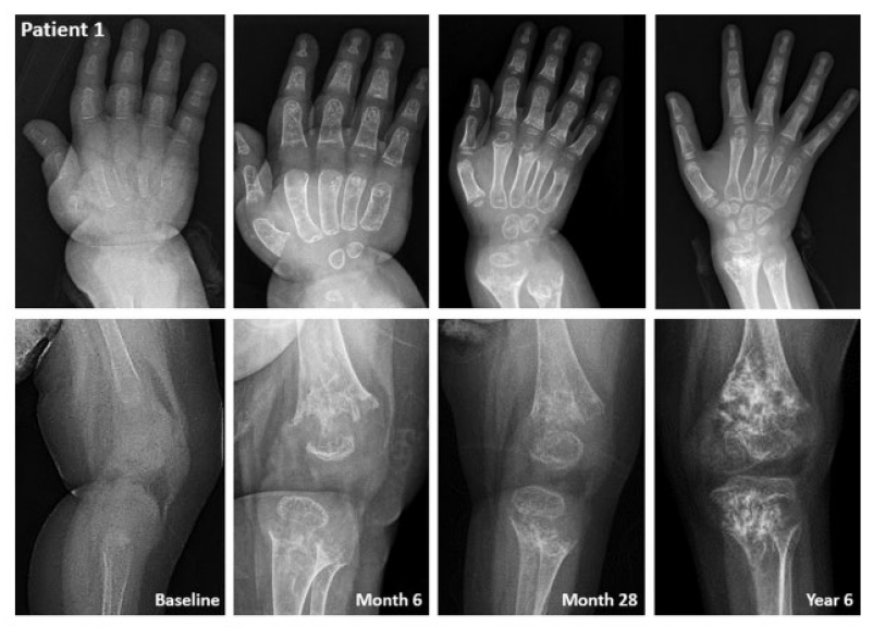 스트렌식 치료 이후 1번 환아의 엑스레이상 변화