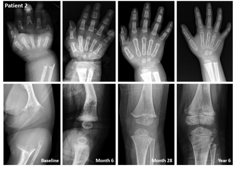 스트렌식 치료 이후 2번 환아의 엑스레이상 변화