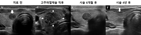 자료. 고주파절제술을 이용한 미세갑상선유두암 치료 과정. 시술 직후 괴사된 종양과 주변부가 넓게 보이지만 시간이 지나면 완전히 소멸됨.