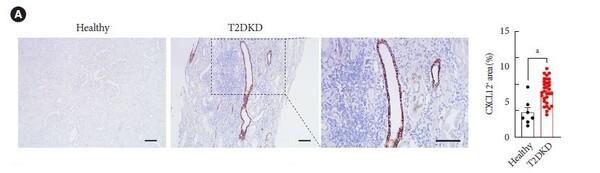 [그림] 당뇨병콩팥병(T2DKD)과 건강한 신장 조직 비교: 당뇨병콩팥병 조직에서는 CXCL12 발현이 증가하며, 특히 T 면역세포가 많이 침투된 부위에서 강하게 나타남. 오른쪽 그래프는 당뇨병콩팥병 환자 그룹이 건강한 그룹에 비해 CXCL12 신장 발현이 증가함을 보여줌. 이는 CXCL12가 당뇨병콩팥병 환자의 신장 염증 진행에 중요한 역할을 한다는 것을 시사함.