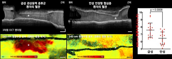 그림 1. 임상적 질환 상태별 관상동맥 동맥경화반의 염증 활성도 평가