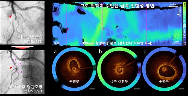 그림 2. 급성 진행성 병변에서 광범위하게 분포하는 치유반 신호의 영상화
