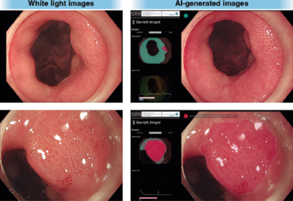사진. 초기 바렛 신생물의 특성 분석한 검사 이미지. 왼쪽은 실제 병변을 촬영한 내시경 검사사진, 오른쪽은 신생물을 예측하여 인공지능이 생성한 이미지. 