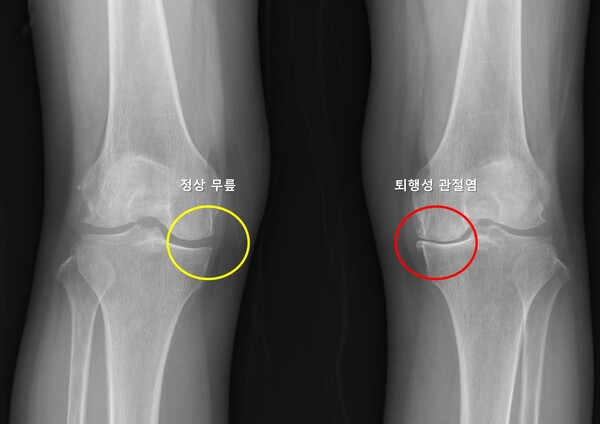 X-ray 이미지. 정상 무릎(노란색)은 관절 간격이 잘 유지되고 뼈 모양이 정상이며, 퇴행성 관절염(빨간색)은 관절 간격이 좁아지고 뼈 모양이 변형됨그림. 반대쪽 무릎 퇴행성 관절염 예측 모델의 주요 변수 중요도: 성별, 반대쪽 무릎의 외측 관절 간격 감소(LJSN), 반대쪽 무릎의 반월판 절제술 수술력(Menisc), 체질량지수(BMI) 순으로 영향을 미침